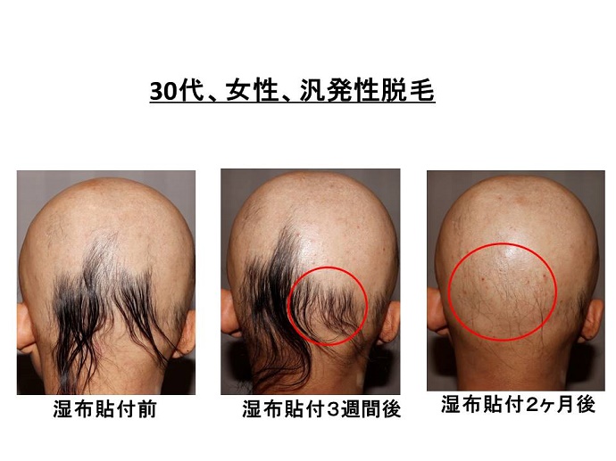 円形脱毛症　病院
